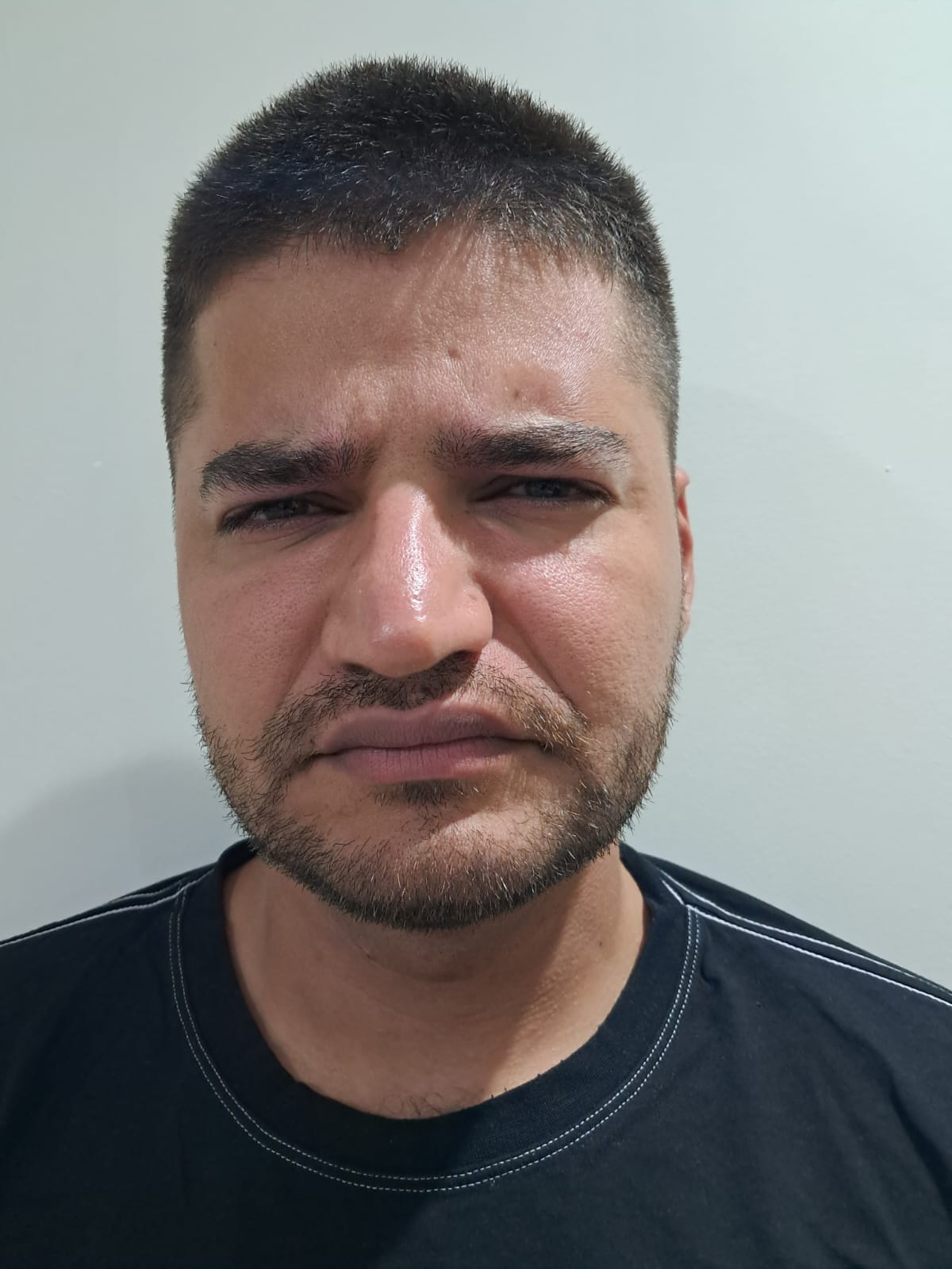 Depois — Rugas de expressão na testa